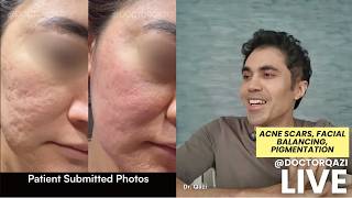 Dr. Qazi Discussing Acne Scars, Facial Balancing, Pigmentation | Unsponsored LIVE | 5.19.2026