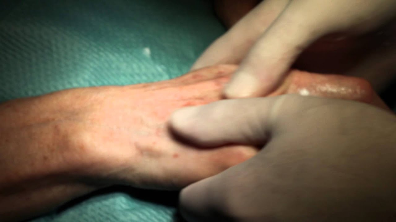 Acide hyaluronique - Volumateur au niveau des mains: Dr Martial Bodnar Toulouse