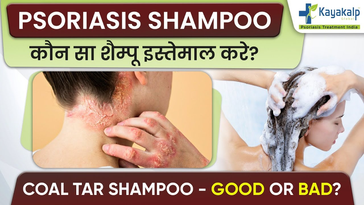 Best Shampoo for Scalp Psoriasis | सोरायसिस में सबसे अच्छा शैम्पू - Coal Tar Psoriasis Shampoo