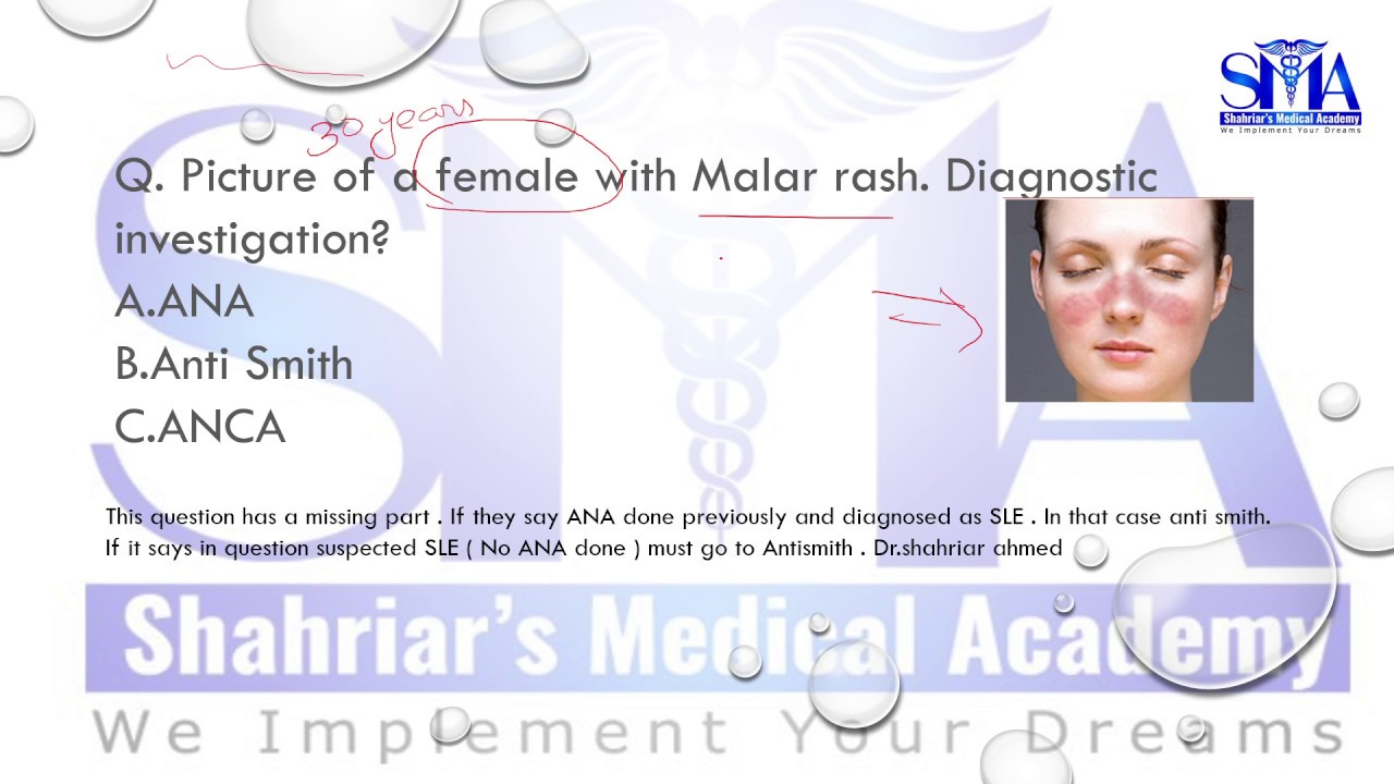 AMC recall |Systemic lupus erythematous