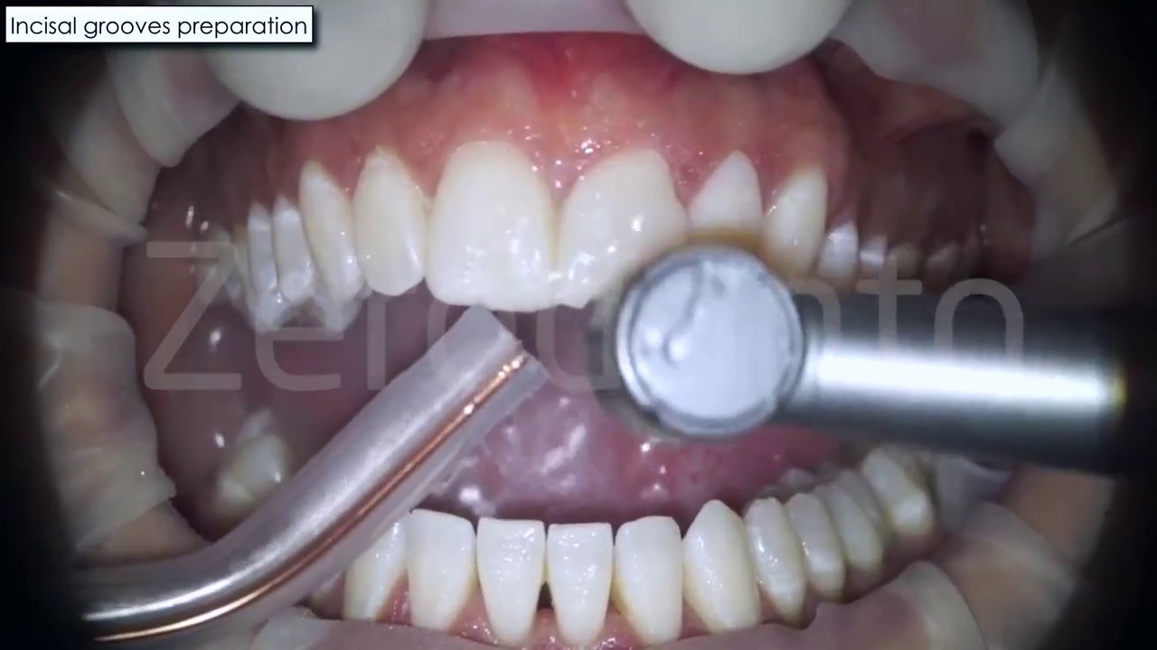 Teeth PreparationMock Up YouTube