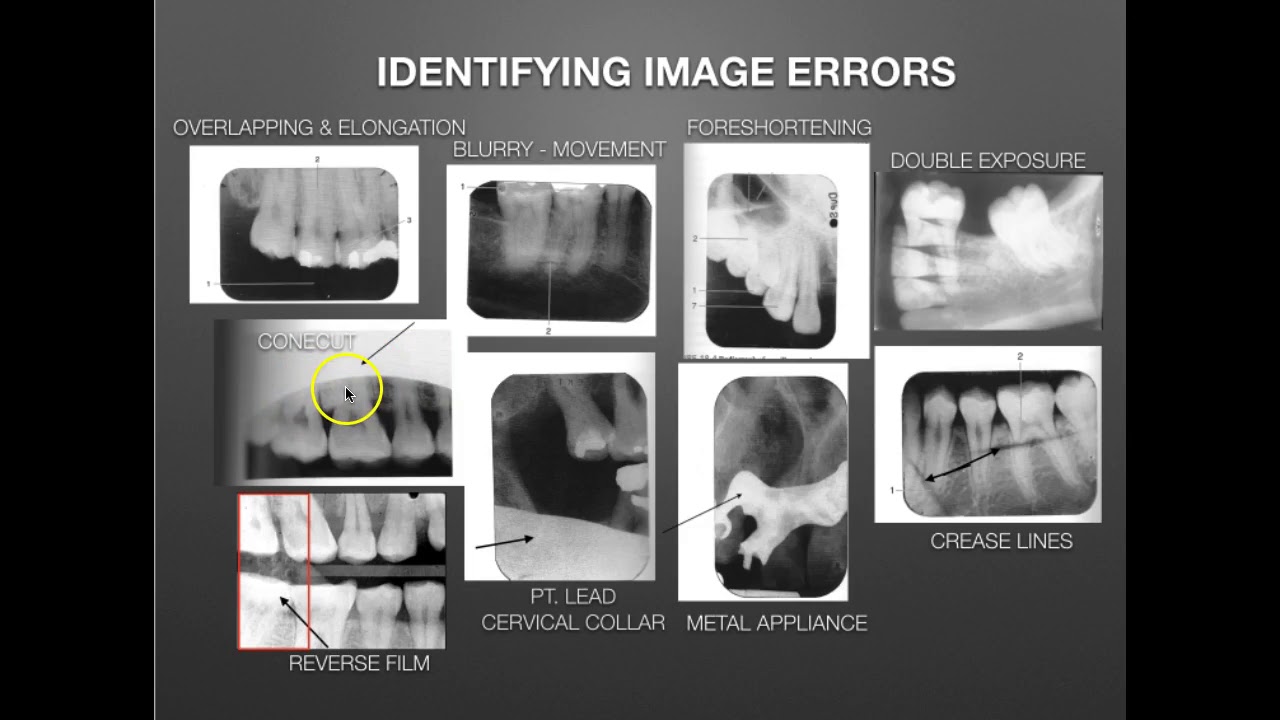 ☢️ FMX Dental X-ray Guide (Are They Safe?)
