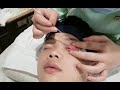 最舒服解压的中国银针洗眼ASMR