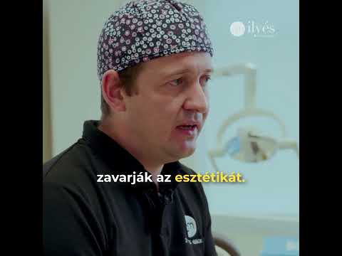 Előnézeti kép: Teljes állcsont rehabilitáció. Mik az előnyeim?