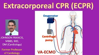Extracorporeal Cpr Ecpr