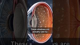 What causes the drifting specks known as eye floaters