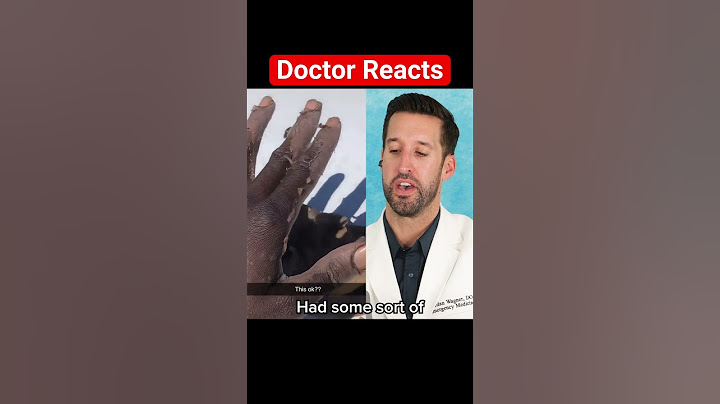 ER Doctor REACTS to Hand Peeling Off