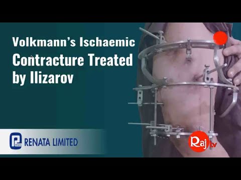 Volkmann&rsquo;s Ischaemic Contracture Treated by Ilizarov - Dr M Bari Lecture Series - OSA-Raj TV