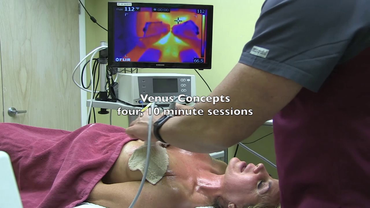 Venus Concepts Radiofrequency Skin Tightening Decolletage Neck
