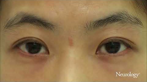 Teaching Video NeuroImages: Macrosaccadic oscillations induced by horizontal head impulses