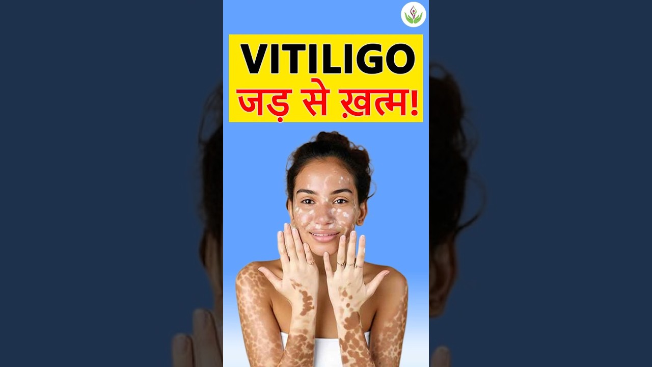 White Patches Treatment | CO2 Fractional Laser, Meru Therapy & Ozone Therapy for Vitiligo