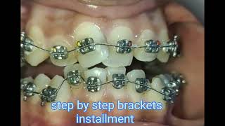 step by step brackets installment.