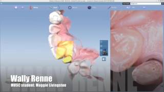 veneer 7 with Planscan using E.max