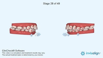 Niềng răng hô bằng invisalign