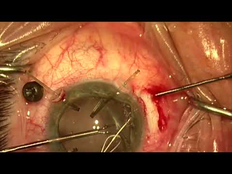 Subluxated cataract, vitreous in AC, atonic pupil: PPV/phaco/ iris cerclage by Steven G. Safran MD
