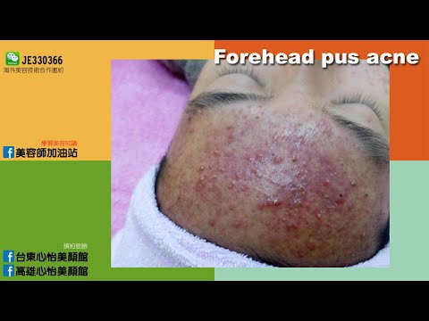 【Je】齊#-Forehead pus acne-Je Lin林季儀老師-台東心怡美顏館-