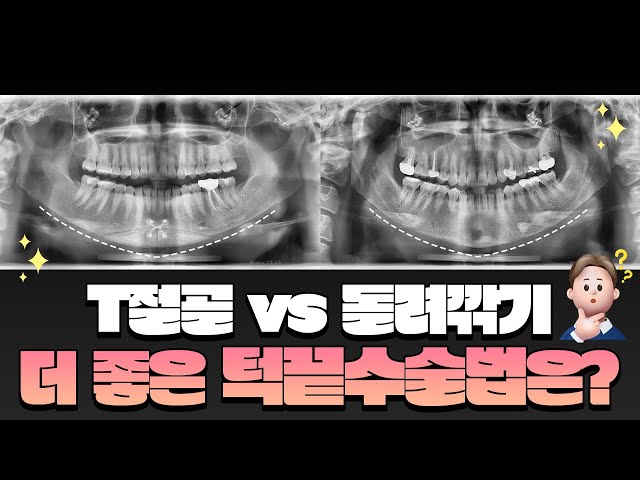 [턱끝수술] T절골 vs 돌려깎기 장단점 비교해보자!
