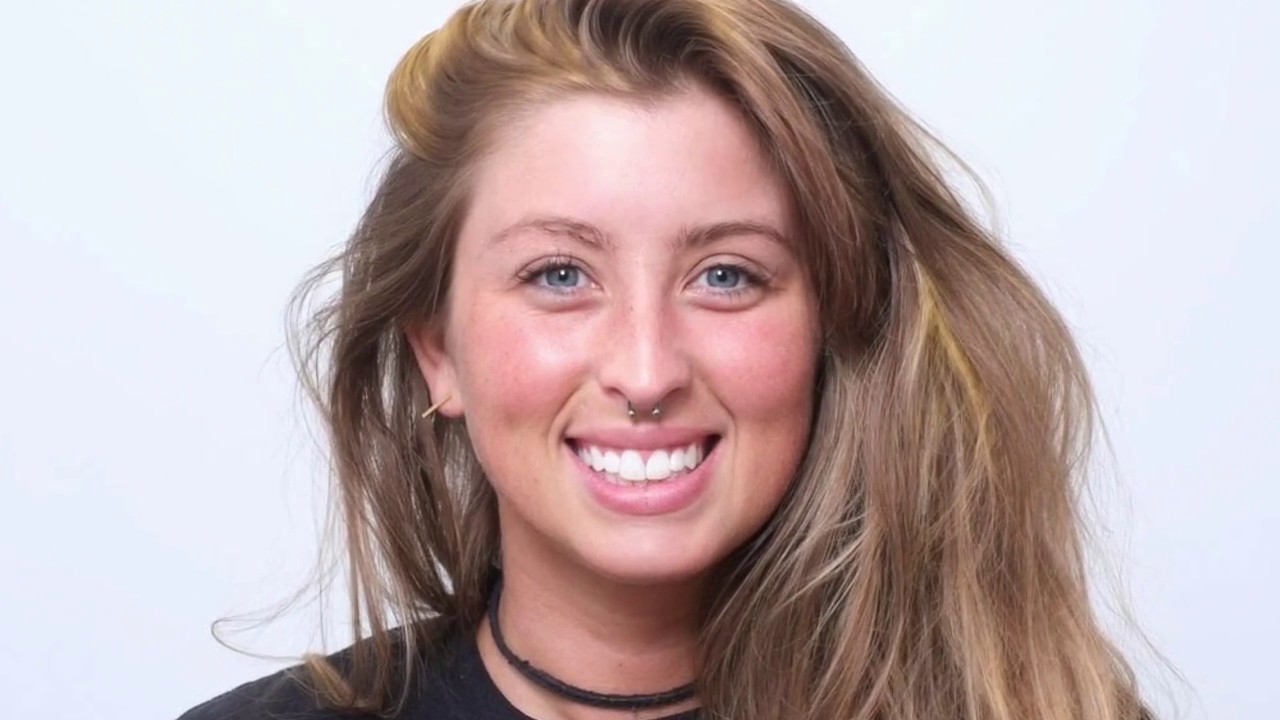 Skye's Direct Composite Veneer