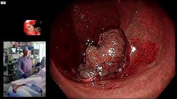 Decision Making in the Rectum: Different to Elsewhere in the Colon