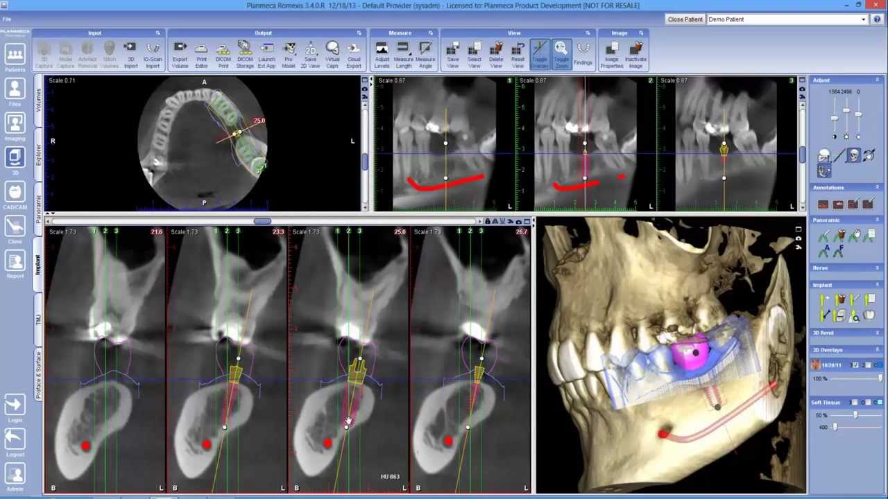 Planmeca Romexis® CAD/CAM module with Planmeca PlanCAD® - YouTube