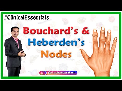 Bouchard’s and Heberden’s nodes : Clinical essentials