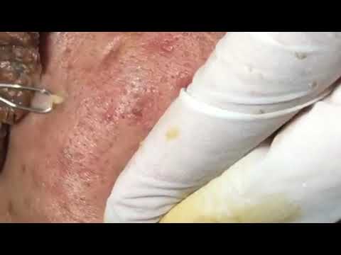cystic acne, pimples and blackheads extraction acne treatment on face!!! part 