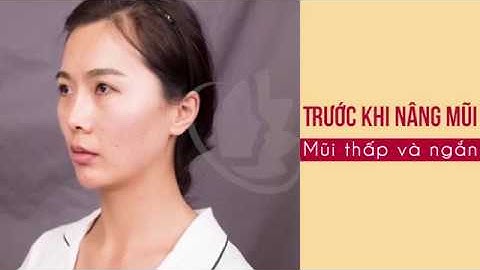 Nhật ký nâng mũi S Line - Khách hàng Trương Mỹ Nhân - Viện thẩm mỹ quốc tế V.I.P