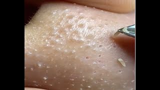 blackheads removal using nipper is so satisfying