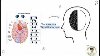 Neuroanatomy Of Visual Field Defects And Pathways Usmle