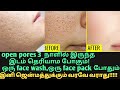 Open pores   2 pack3   open pores large pores remedy tamil