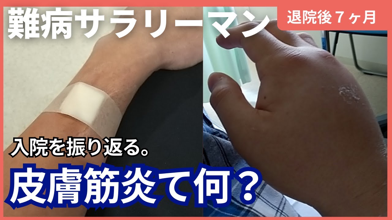 皮膚筋炎とは何ですか?