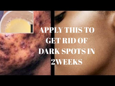 How To: Remove dark spots and acne scars, sunburn and hyper