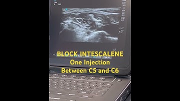 #anesthesia BLOCK INTERSCALENE NYSORA STYLE 1 Injection between C5-C6