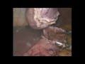 Laparoscopic gastric gist ressection