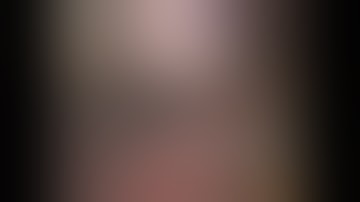 Laparoscopic Gastric G.I.S.T. Ressection