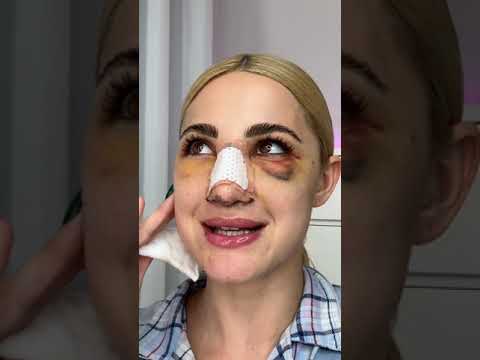 Ιωάννα Τούνη: Πήρα χόνδρο από το πλευρό μου για να φτιάξω τη μύτη μου