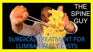 Surgical Treatment for Lumbar Facet Cysts