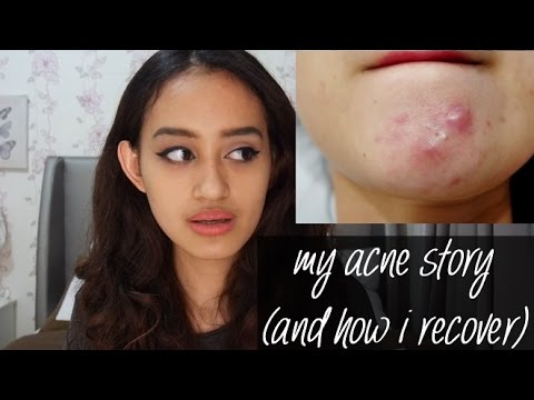 How to Cure Acne & Get Clear Skin | My Acne Story | Nadya Aqilla