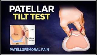 Patellar Tilt Test | Patellofemoral Pain