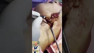 Submandibular salivary gland excision (steps and how to protect related nerves from injury  )