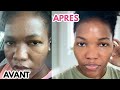 Utilise Ceci  Pour 1 Visage Lisse Claire Sans Tâches et Boutons - Peau Grasse, Acnéique, Sèche