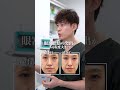 クマ取り▶40代女性(ハリを出しながらクマを改善)