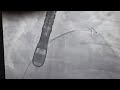 PFO Closure by Amplatz device Tricks