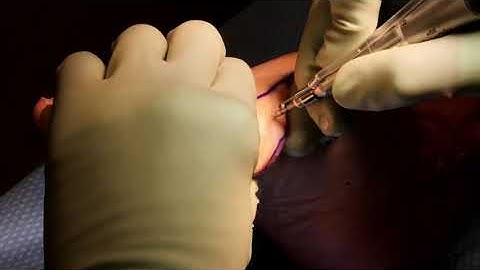Minimally Invasive Bunion Correction:  A visual on the Incision
