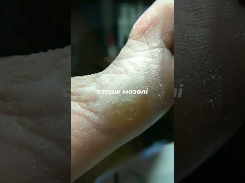 стержневая мозоль на стопе - YouTube