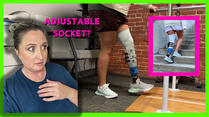 Below The Knee amputee review of Martin Bionics adjustable socket for prosthetic leg