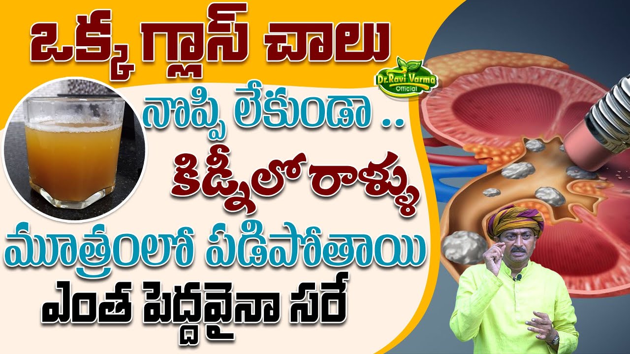 ఒక్క గ్లాస్ చాలునొప్పి లేకుండా కిడ్నీలో రాళ్ళు మూత్రంలో పడిపోతాయి | Kidney | Dr.Ravivarma Official