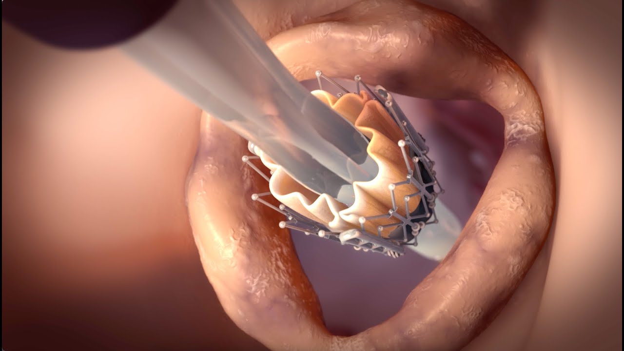 Transcatheter Aortic Valve Implantation TAVI