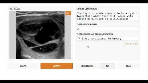 Artificial intelligence generating description for thyroid nodule