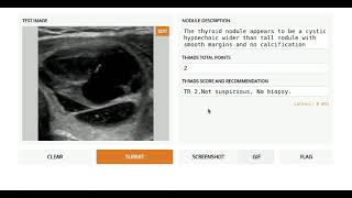 Artificial intelligence generating description for thyroid nodule
